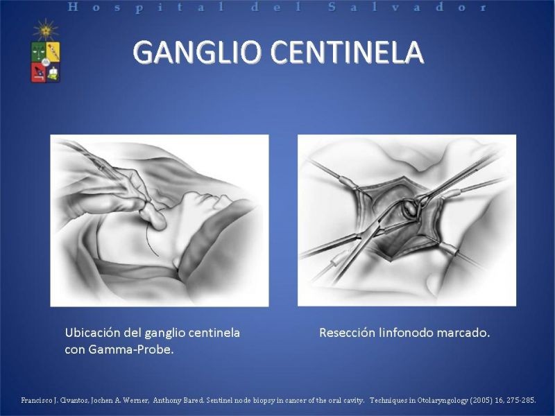 Diapositiva 7 de Biopsia de Ganglio Centinela en Cáncer de Cabeza y Cuello