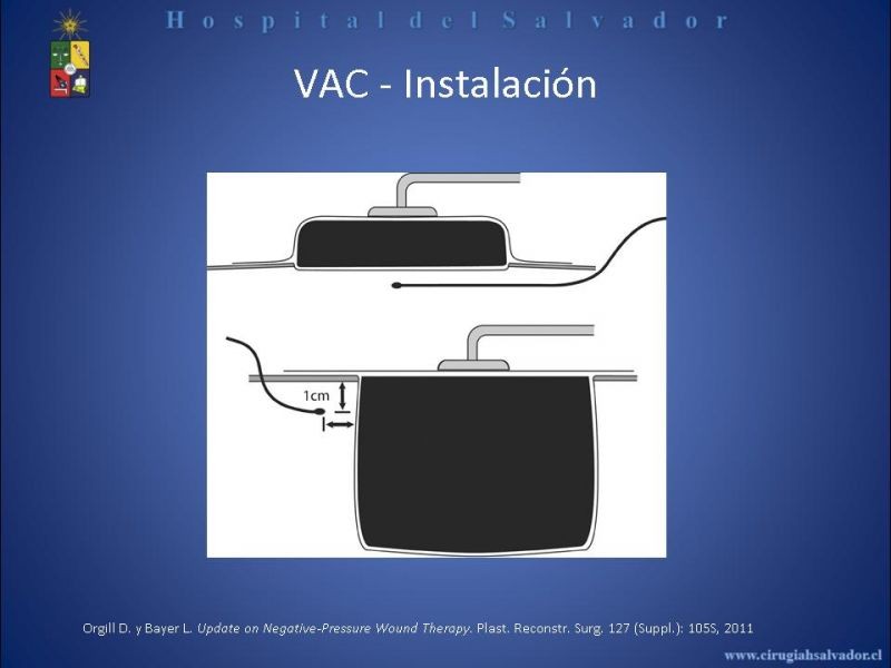 Diapositiva 3 de VAC e injertos dérmicos