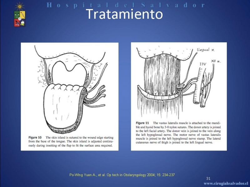 Diapositiva 30 de Cáncer de Lengua