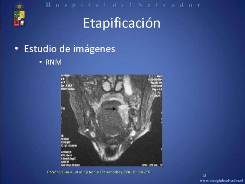 Diapositiva 14 de Cáncer de Lengua