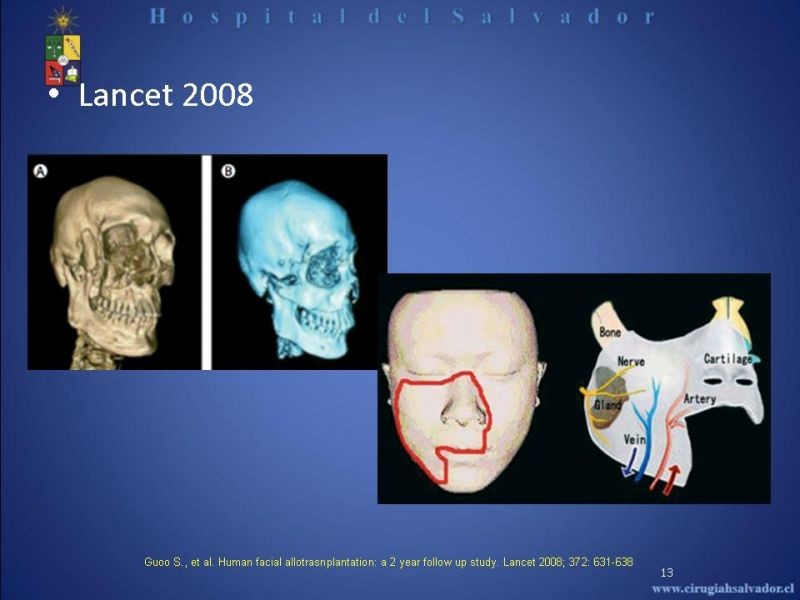 Diapositiva 12 de Transplante Facial