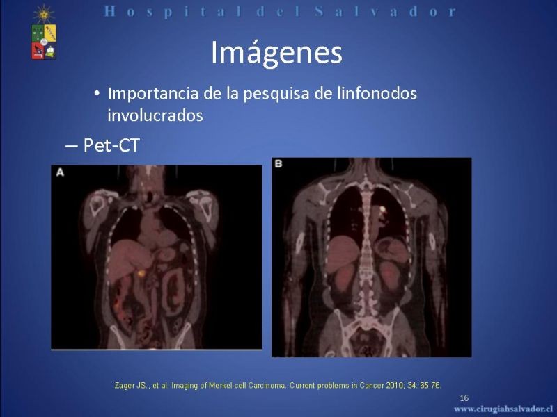Diapositiva 15 de Carcinoma de Células de Merkel