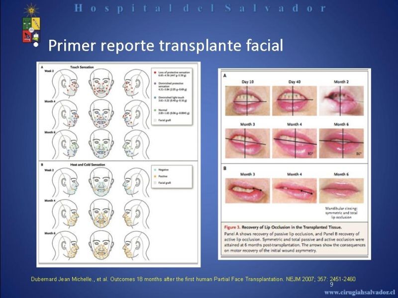 Diapositiva 8 de Transplante Facial