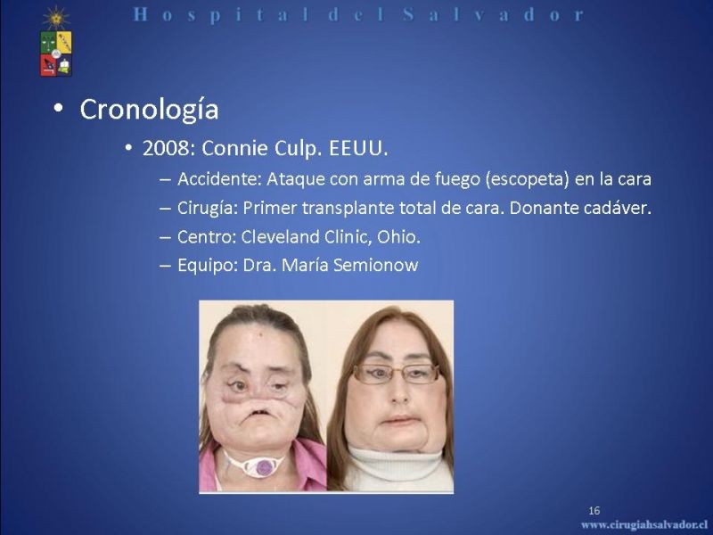Diapositiva 15 de Transplante Facial