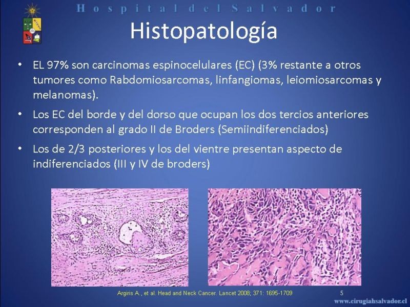 Diapositiva 4 de Cáncer de Lengua