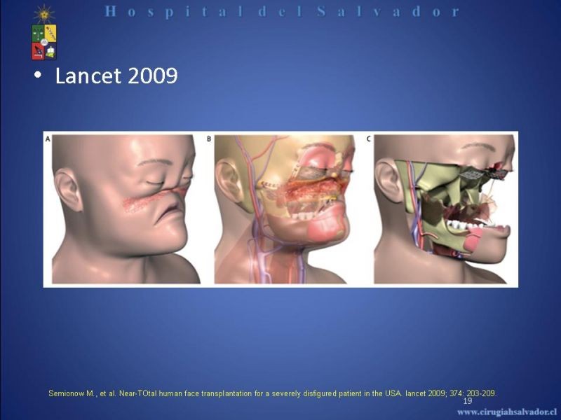 Diapositiva 18 de Transplante Facial