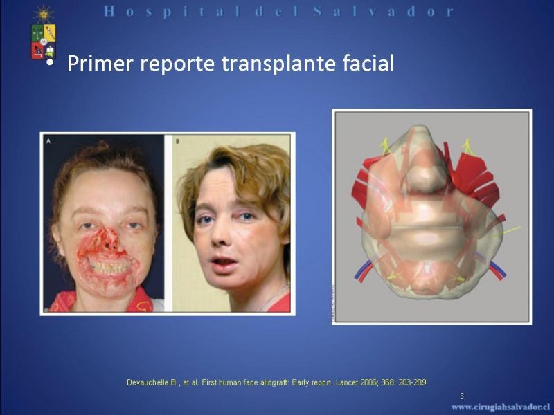 Diapositiva 4 de Transplante Facial