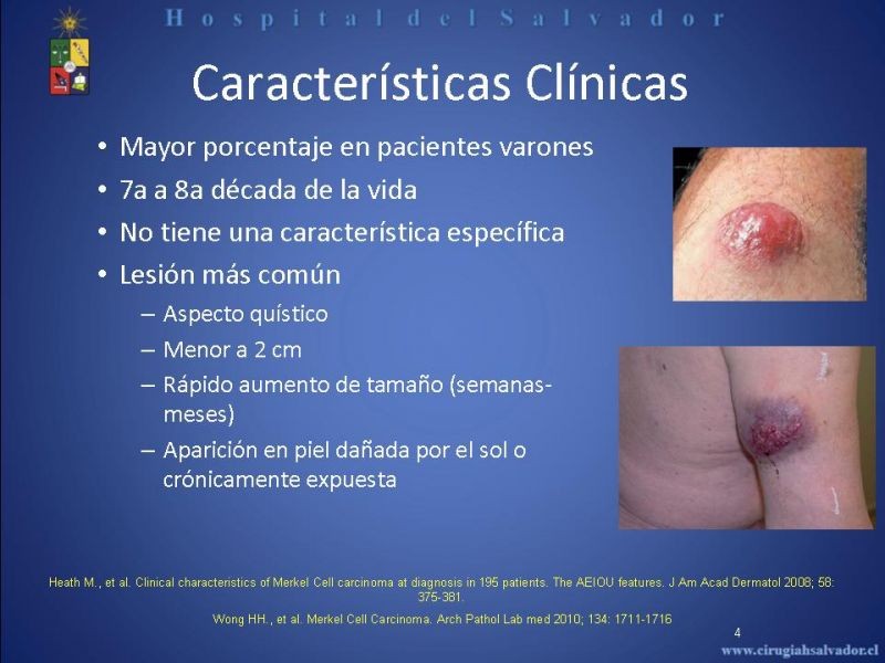 Diapositiva 3 de Carcinoma de Células de Merkel