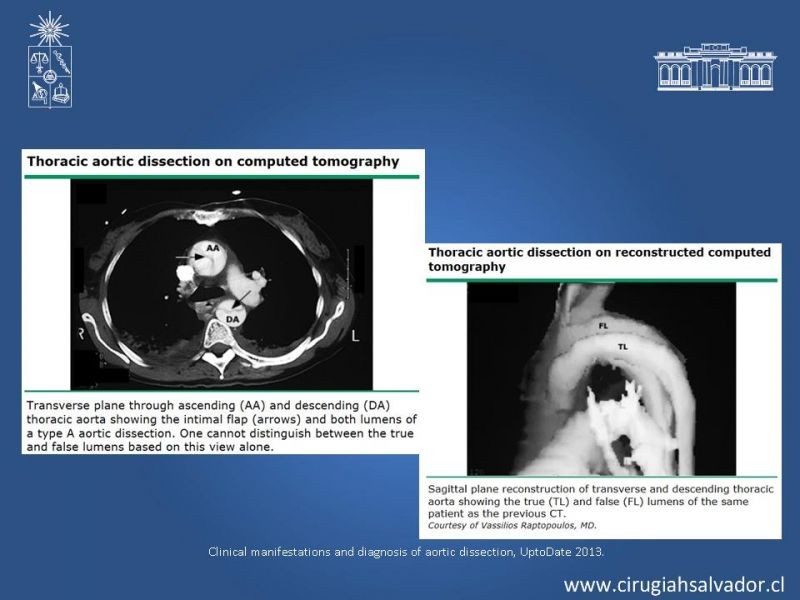 Diapositiva 12 de Disección aórtica tipo B manejo actual