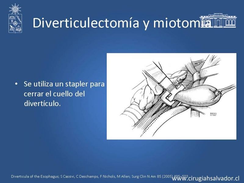 Diapositiva 14 de Tratamiento quirúrgico del divertículo de Zenker