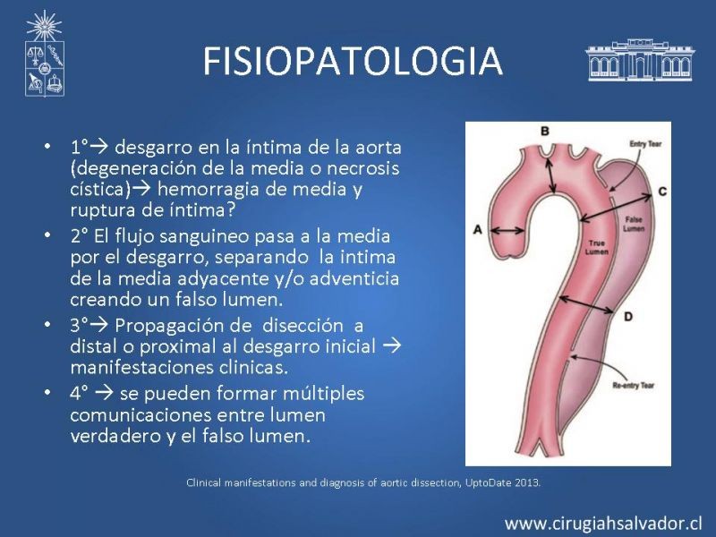 Diapositiva 2 de Disección aórtica tipo B manejo actual