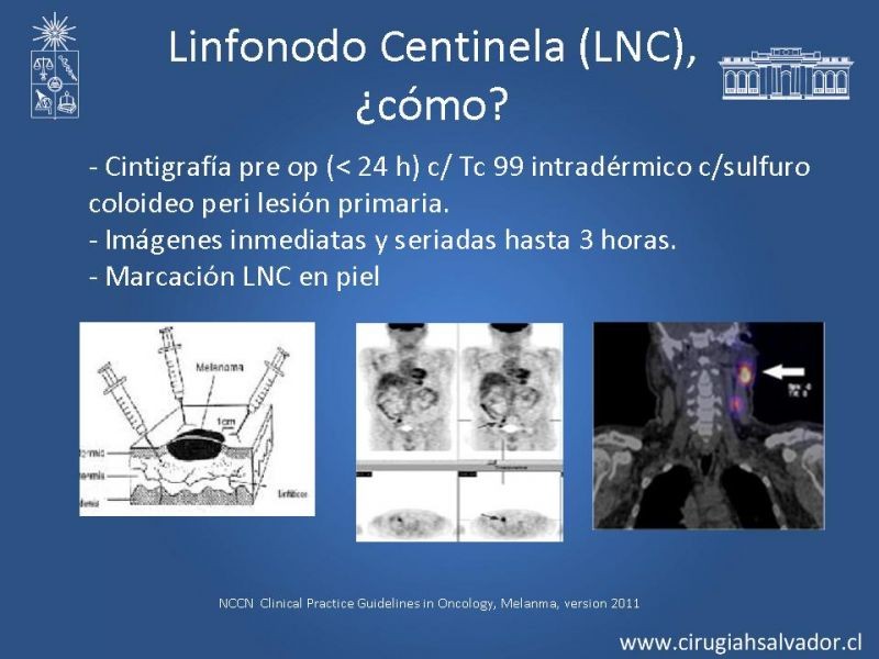 Diapositiva 21 de Manejo Quirúrgico de Melanoma