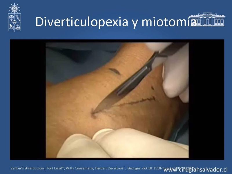 Diapositiva 12 de Tratamiento quirúrgico del divertículo de Zenker