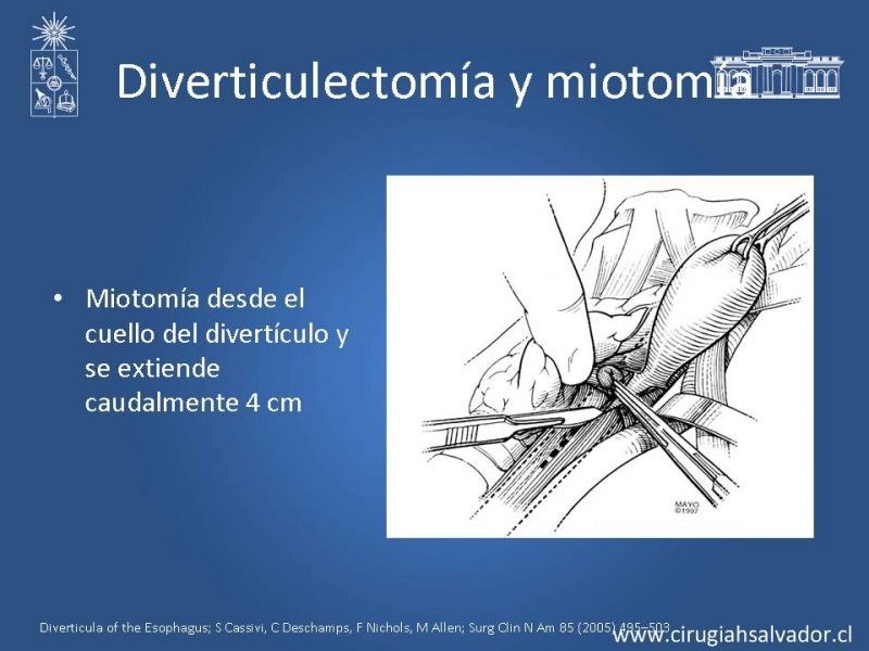Diapositiva 13 de Tratamiento quirúrgico del divertículo de Zenker