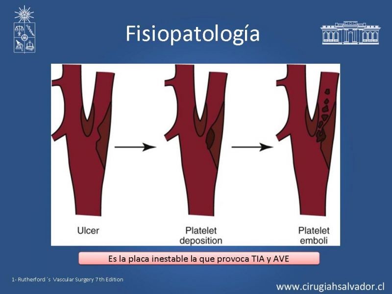 Diapositiva 6 de Estenosis Carotídea