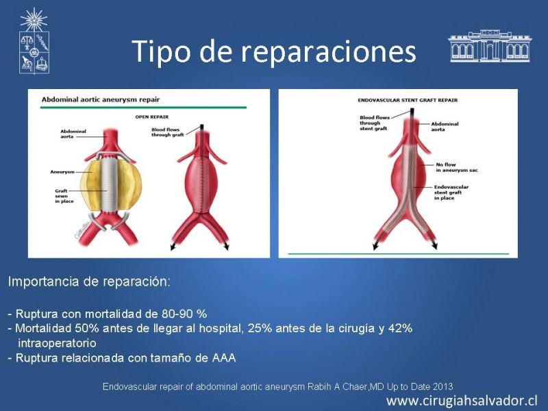 Diapositiva 2 de Resultados en el manejo de AAA infrarrenal (EVAR) 
