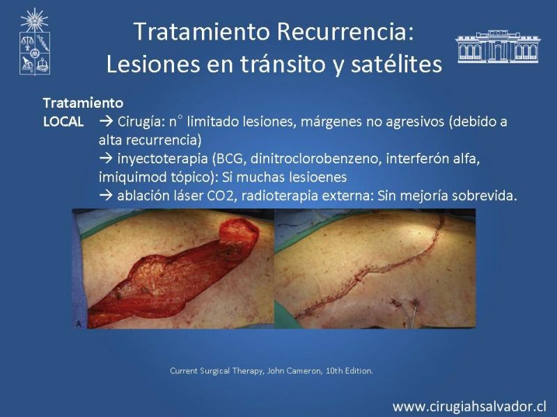 Diapositiva 28 de Manejo Quirúrgico de Melanoma