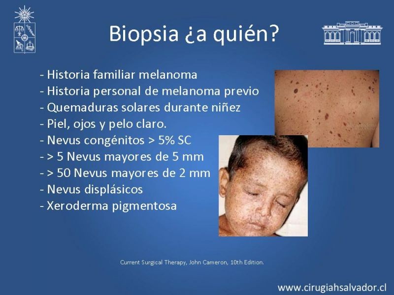 Diapositiva 5 de Manejo Quirúrgico de Melanoma