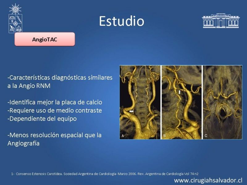Diapositiva 10 de Estenosis Carotídea