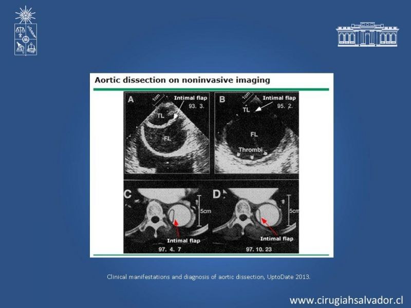 Diapositiva 11 de Disección aórtica tipo B manejo actual