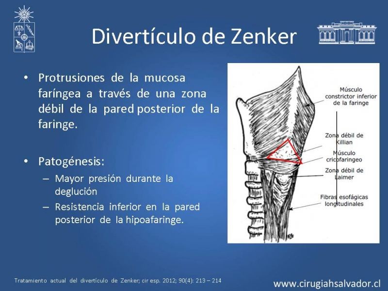 Diapositiva 1 de Tratamiento quirúrgico del divertículo de Zenker