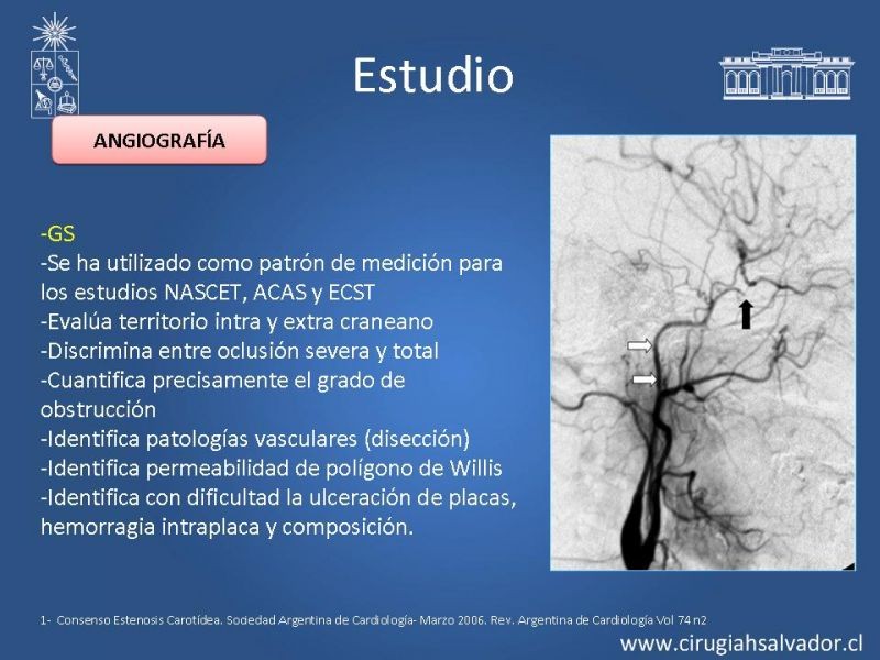 Diapositiva 9 de Estenosis Carotídea