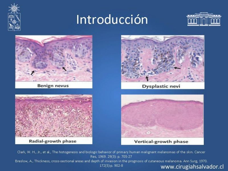 Diapositiva 3 de Manejo Quirúrgico de Melanoma