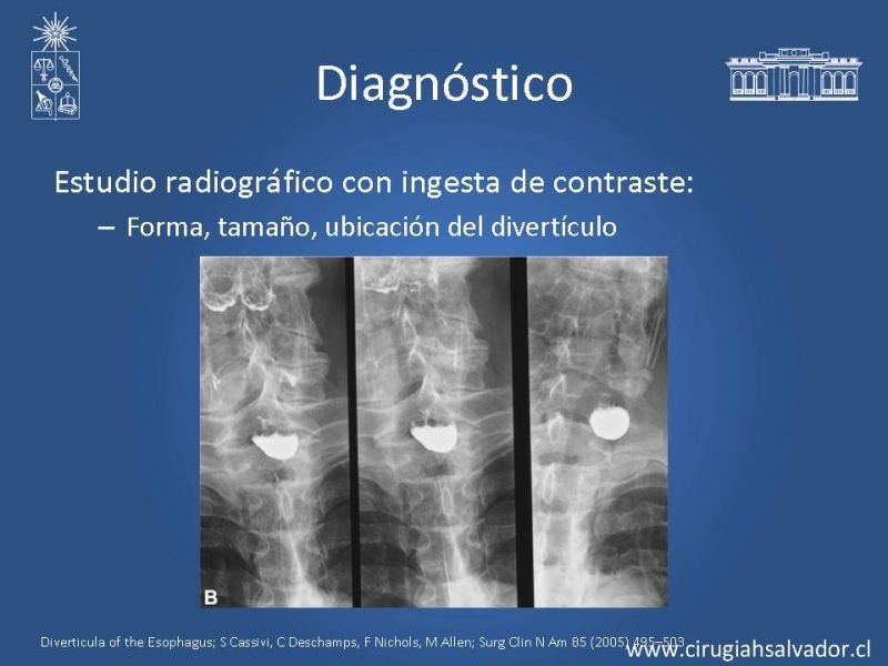 Diapositiva 4 de Tratamiento quirúrgico del divertículo de Zenker