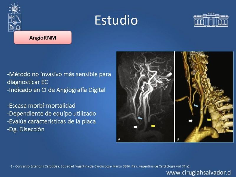 Diapositiva 11 de Estenosis Carotídea