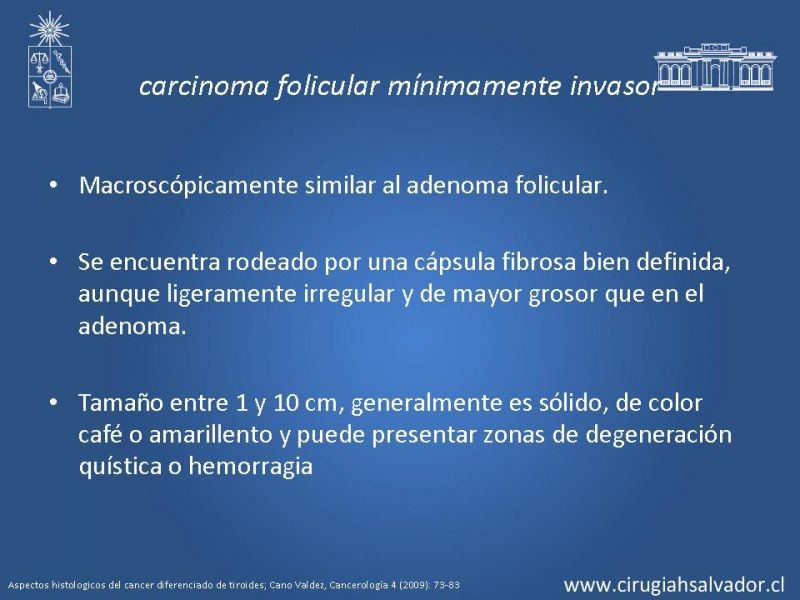 Diapositiva 15 de Cáncer de tiroides no papilar