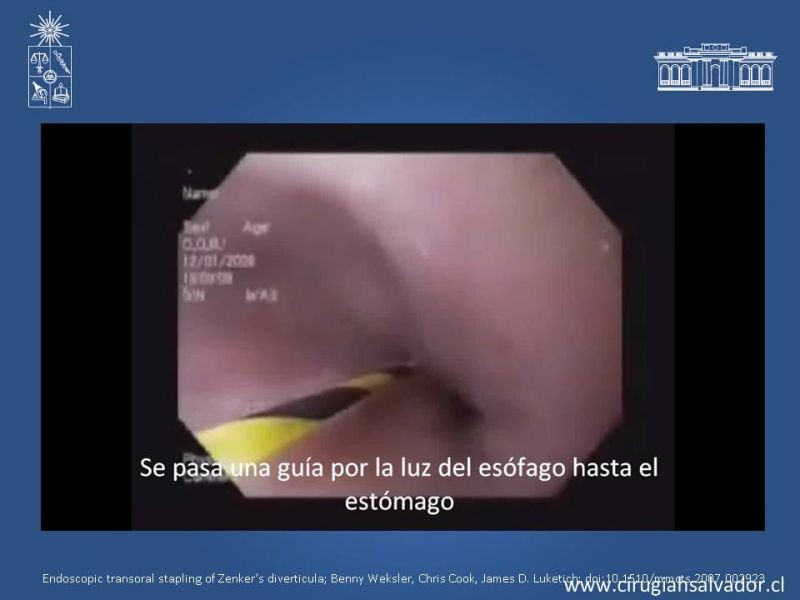 Diapositiva 10 de Tratamiento quirúrgico del divertículo de Zenker