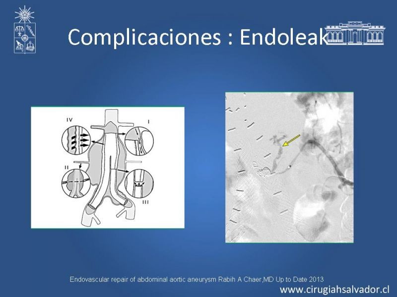 Diapositiva 18 de Resultados en el manejo de AAA infrarrenal (EVAR) 