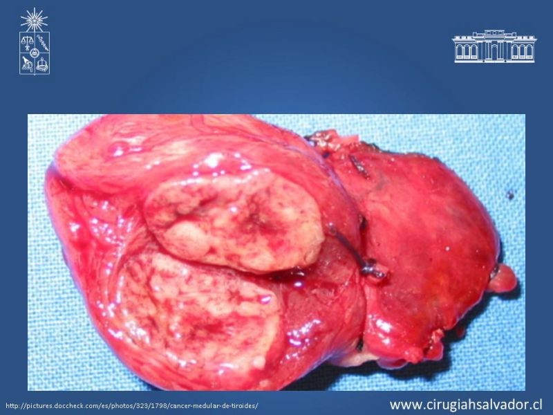 Diapositiva 29 de Cáncer de tiroides no papilar