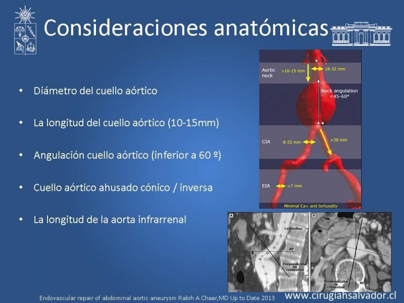 Diapositiva 4 de Resultados en el manejo de AAA infrarrenal (EVAR) 