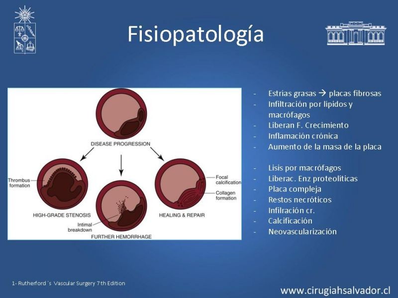 Diapositiva 5 de Estenosis Carotídea