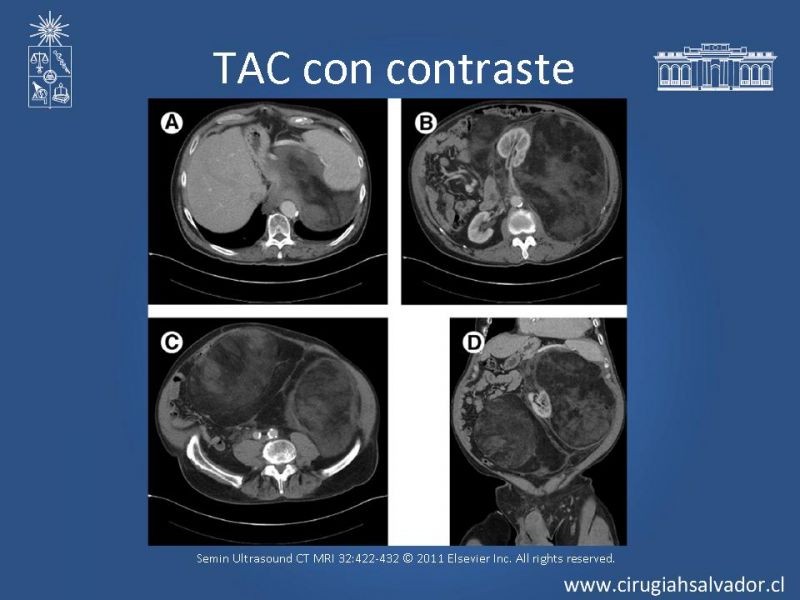 Diapositiva 13 de Sarcoma retroperitoneal