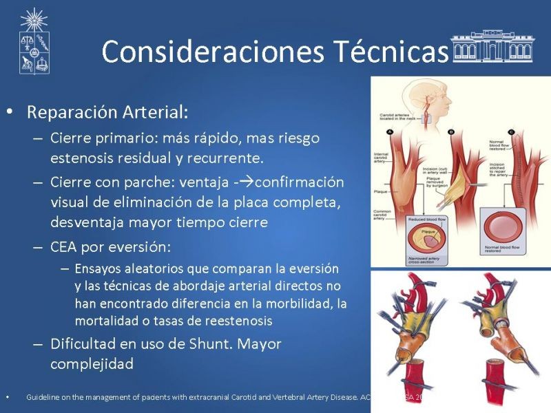 Diapositiva 53 de Manejo de pacientes con Enfermedad Carotídea Extracraneal Asintomáticos