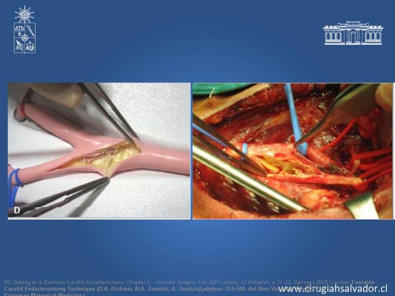 Diapositiva 39 de Manejo de pacientes con Enfermedad Carotídea Extracraneal Asintomáticos