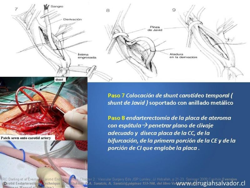 Diapositiva 40 de Manejo de pacientes con Enfermedad Carotídea Extracraneal Asintomáticos