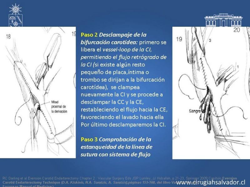 Diapositiva 45 de Manejo de pacientes con Enfermedad Carotídea Extracraneal Asintomáticos
