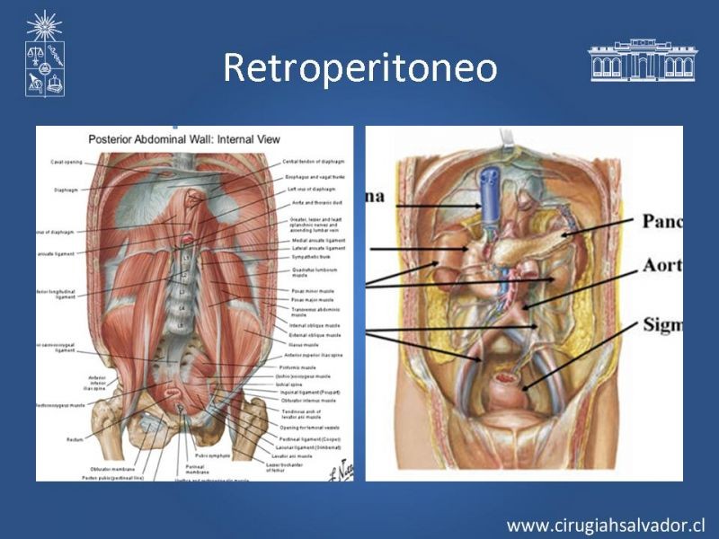 Diapositiva 2 de Sarcoma retroperitoneal