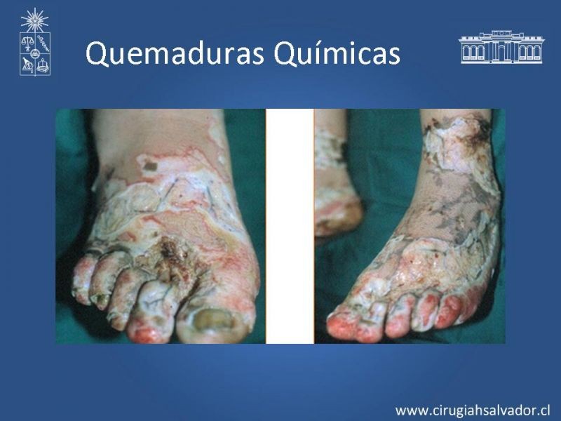 Diapositiva 19 de Quemaduras