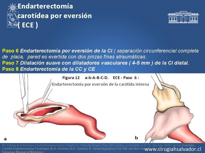 Diapositiva 49 de Manejo de pacientes con Enfermedad Carotídea Extracraneal Asintomáticos