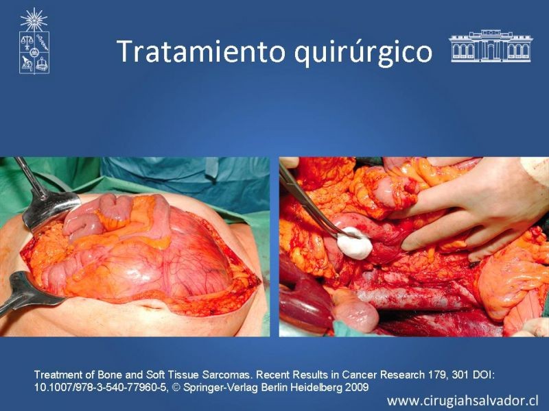 Diapositiva 18 de Sarcoma retroperitoneal