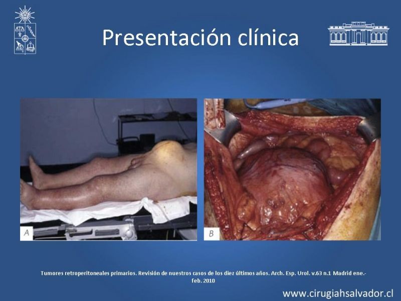 Diapositiva 5 de Sarcoma retroperitoneal