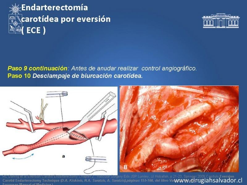 Diapositiva 52 de Manejo de pacientes con Enfermedad Carotídea Extracraneal Asintomáticos
