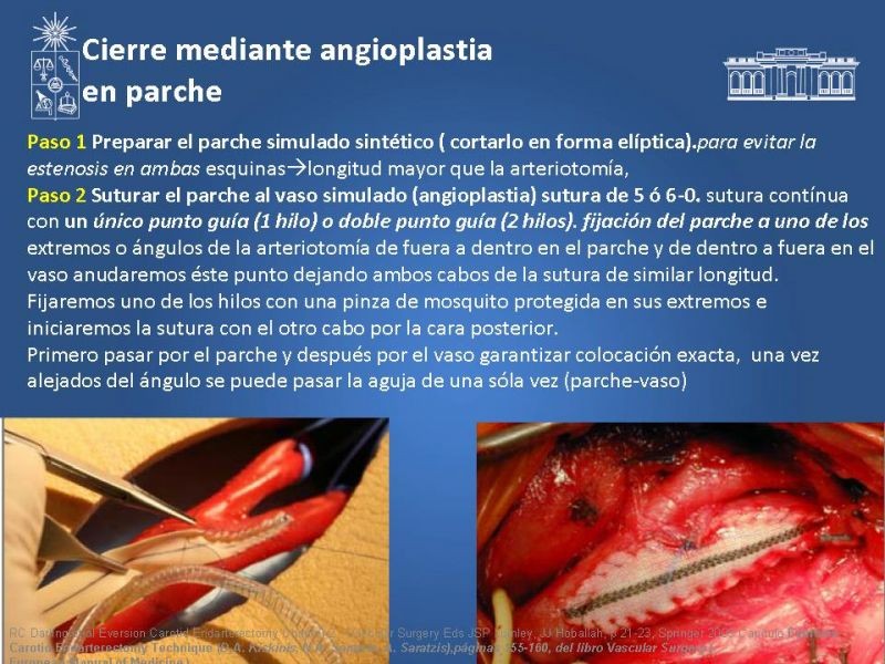 Diapositiva 46 de Manejo de pacientes con Enfermedad Carotídea Extracraneal Asintomáticos