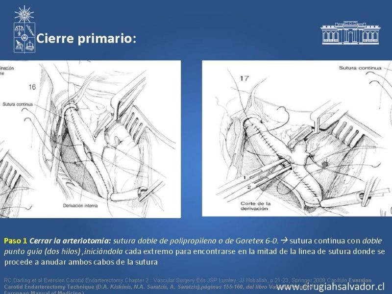 Diapositiva 44 de Manejo de pacientes con Enfermedad Carotídea Extracraneal Asintomáticos