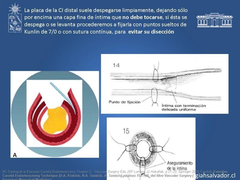 Diapositiva 41 de Manejo de pacientes con Enfermedad Carotídea Extracraneal Asintomáticos