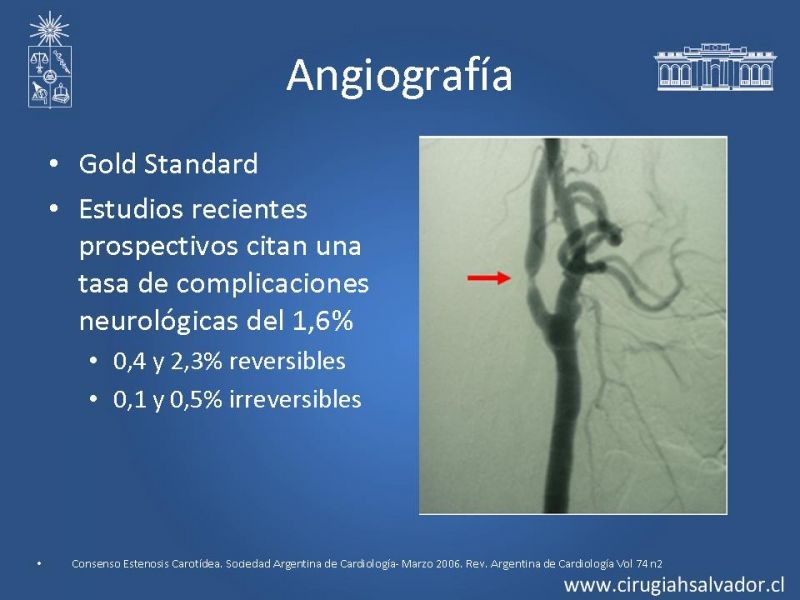 Diapositiva 14 de Manejo de pacientes con Enfermedad Carotídea Extracraneal Asintomáticos